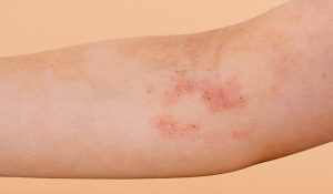 Viêm da tiếp xúc có thể xuất hiện ở nhiều nguyên nhân.